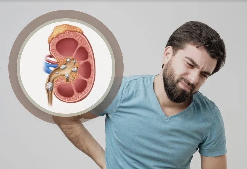 چه عواملی باعث ایجاد سنگ کلیه می‌شوند و چگونه می‌توان از آن‌ها پیشگیری کرد؟