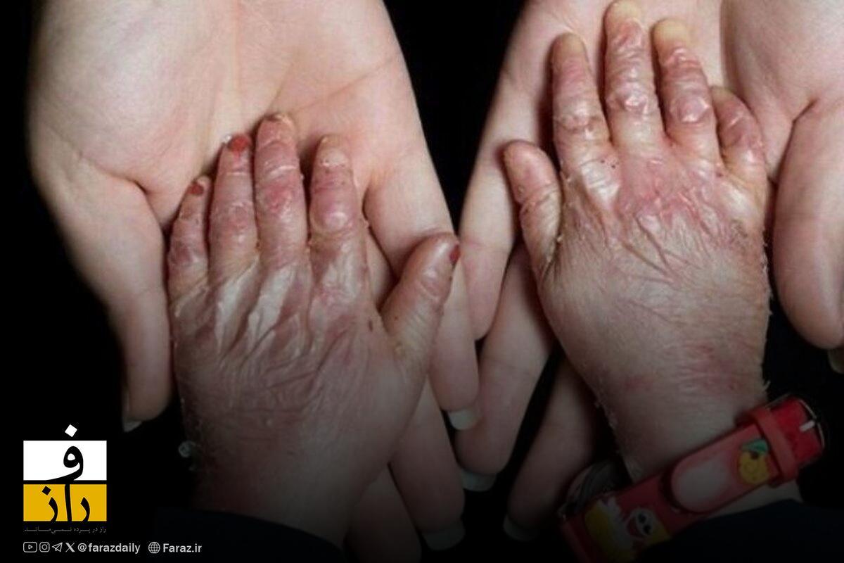 مدیر خانه بیماران پروانه‌ای: بنیاد بیماری‌های خاص به ما کمک نمی‌کند